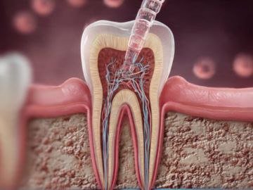 Root Canals